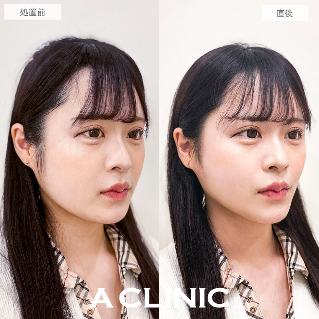 Aスレッドで輪郭の左右差が改善して韓国アイドルのようなVライン輪郭になりました！こちら処置前と直後の症例です。(10代女性)
