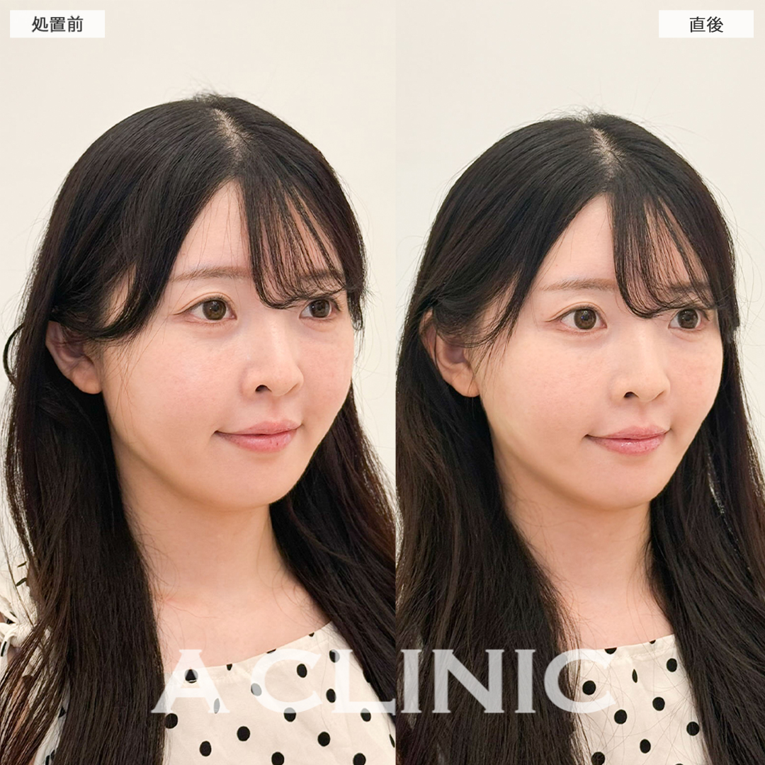 Aスレッドでフェイスラインのもたつき解消！こちら処置前と直後の症例です(30代女性)