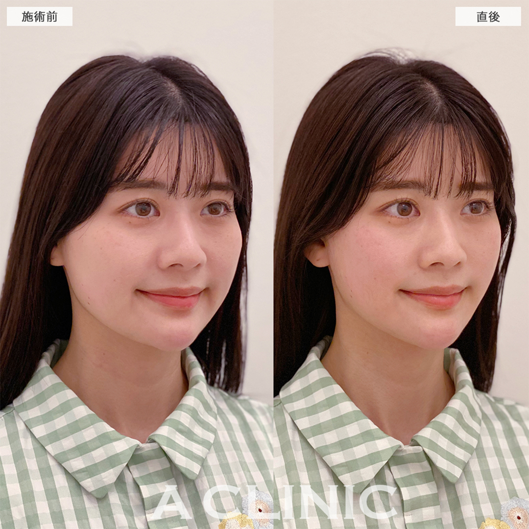 Aスレッドで余白ゼロの綺麗な輪郭になりました！こちら処置前と直後の症例です(30代女性)