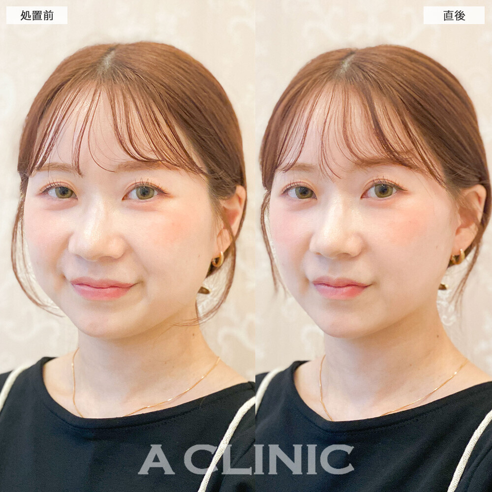 Aスレッドで丸顔からすっきりした印象に！こちら処置前と直後の症例です(20代女性)