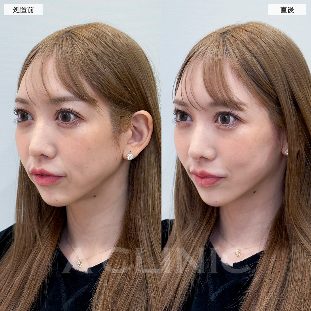 Aスレッドでフェイスラインのたるみがなかったことに！処置前と直後の症例です(30代女性)