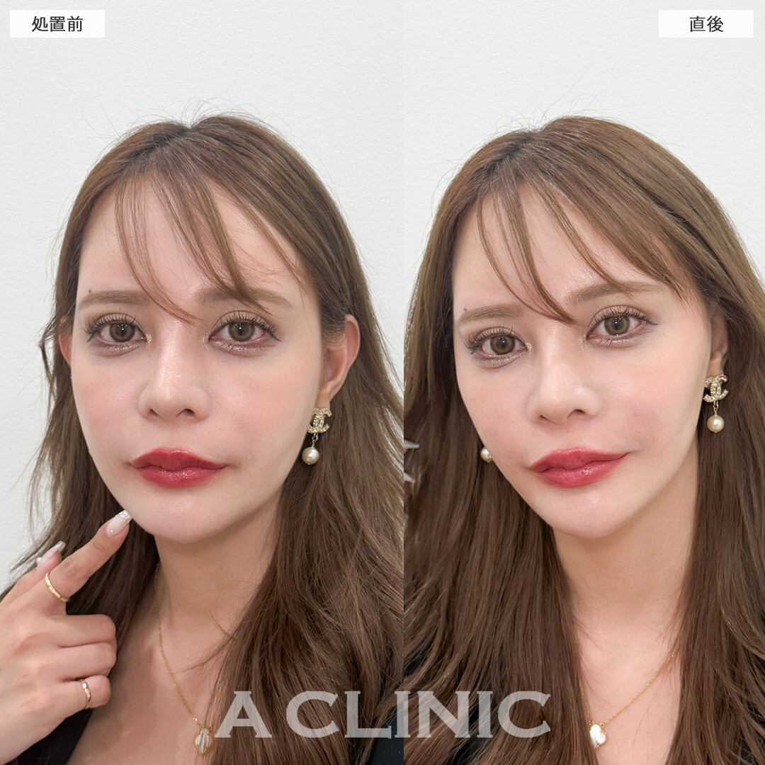 Aスレッドで見惚れる輪郭ができました！こちら処置前と直後の症例です(30代女性)