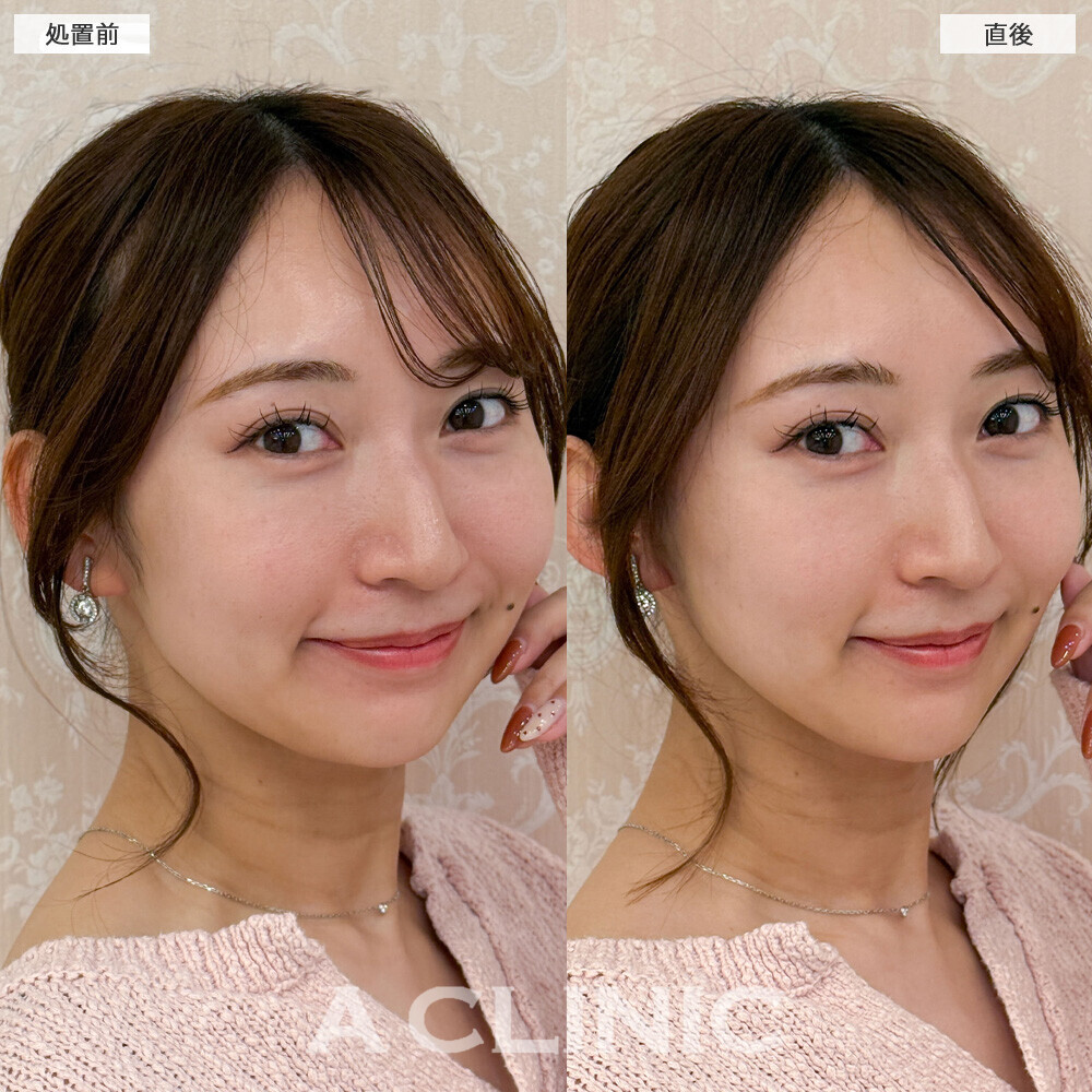 Aスレッドで頬のたるみがしっかりリフトアップされました！こちら処置前と直後の症例です(20代女性)