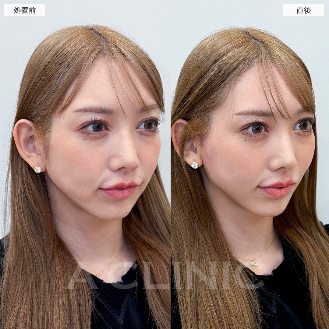 Aスレッドでフェイスラインのたるみがなかったことに！処置前と直後の症例です(30代女性)