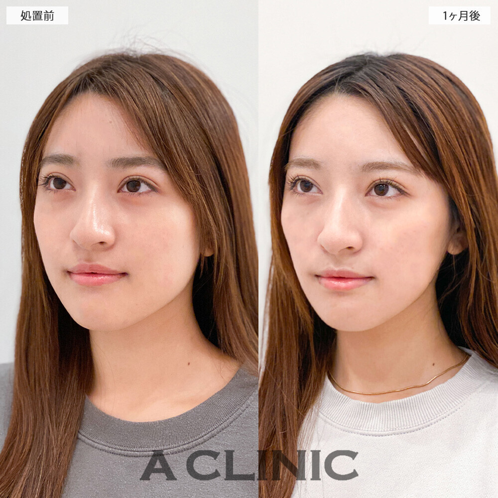 Aスレッドと小顔エラボトックスでフェイスラインがスッキリしました！こちら処置前と1ヶ月後の症例です。(20代女性)