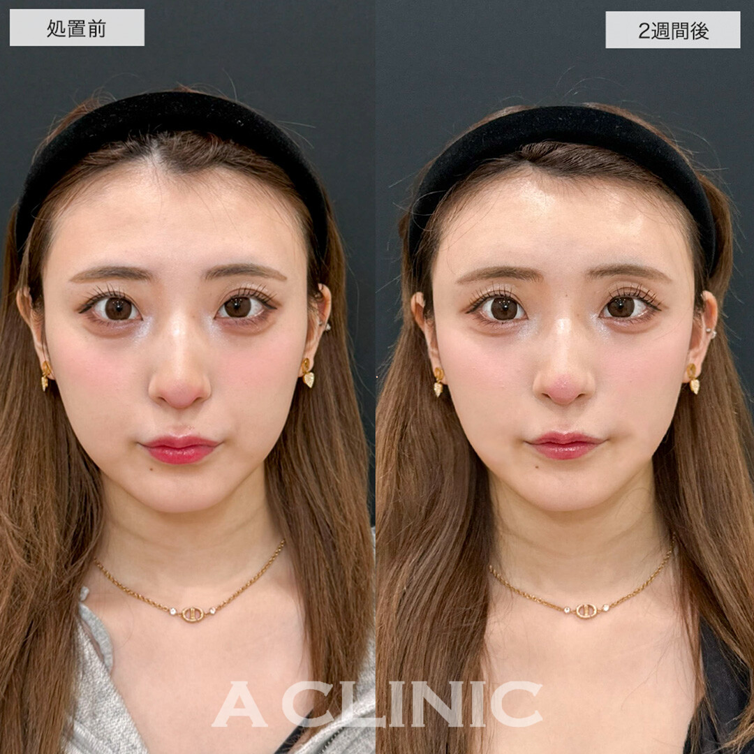 ヒアルロン酸カスタマイズメニューで周りにバレずにこっそり垢抜け!こちら処置前と2週間後の症例です(20代女性)