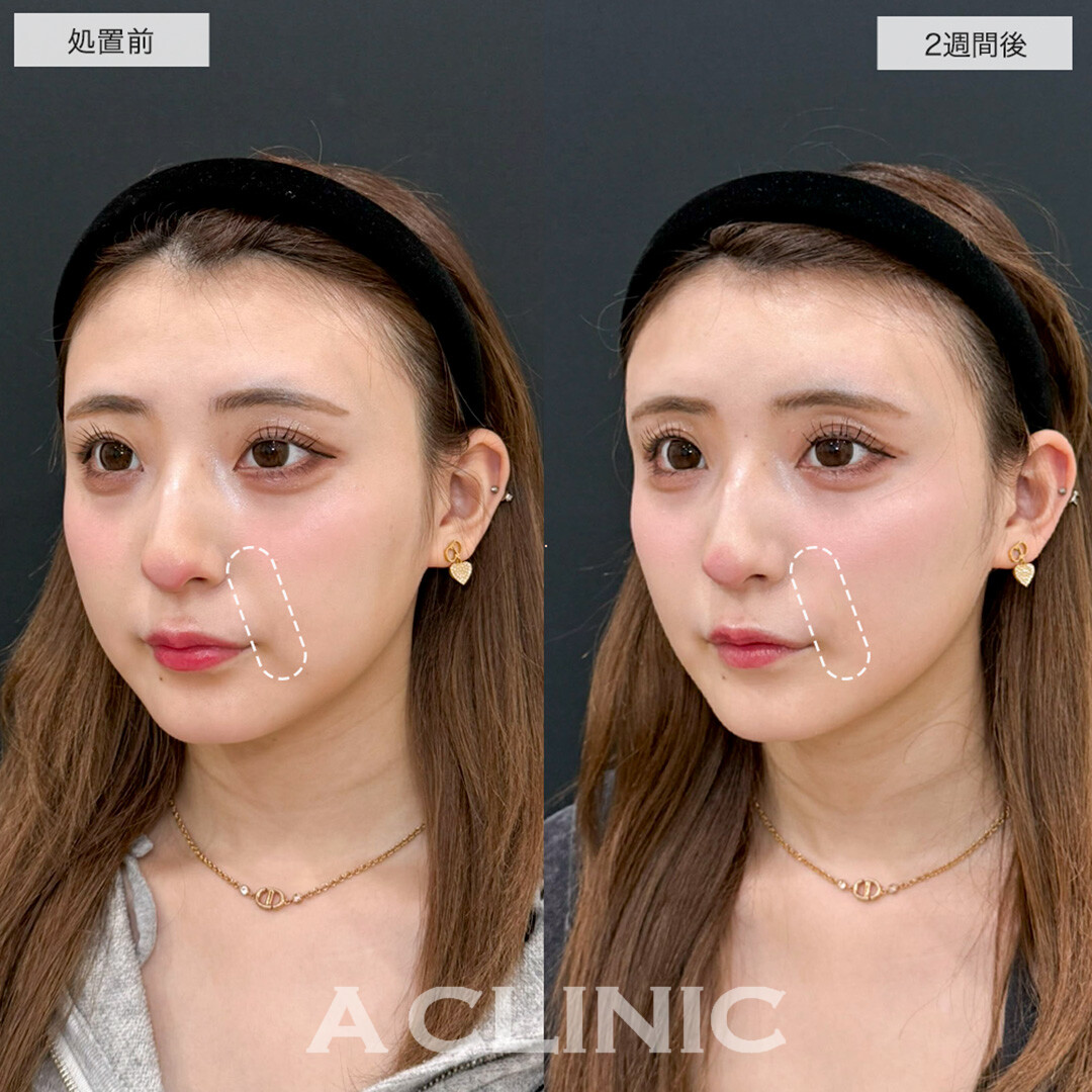 ヒアルロン酸カスタマイズメニューで周りにバレずにこっそり垢抜け!こちら処置前と2週間後の症例です(20代女性)