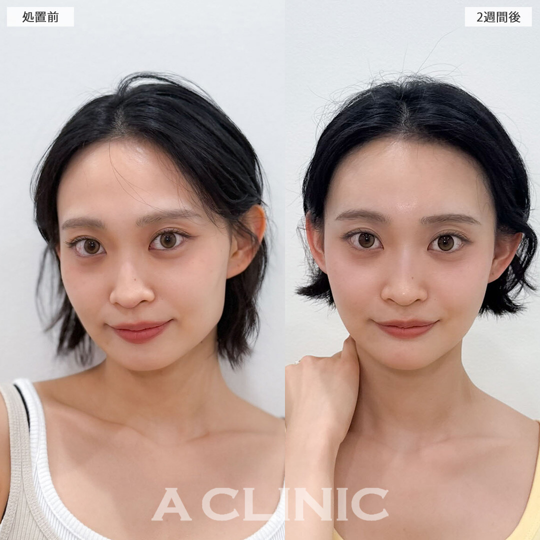 ヒアルロン酸カスタマイズメニューは注入だけで輪郭を整えることが出来ます！こちら処置前と2週間後の症例です(20代女性)