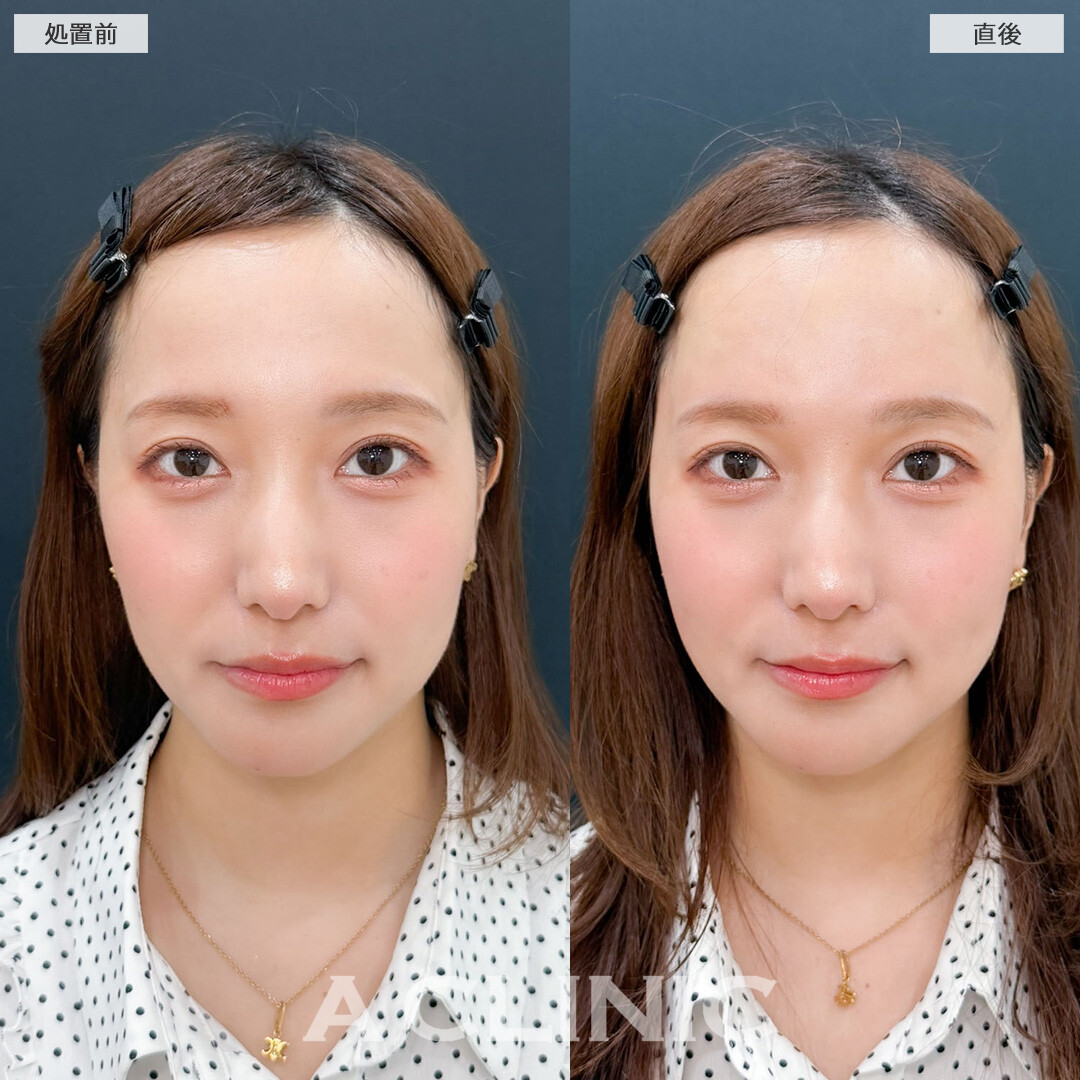 ヒアルロン酸カスタマイズメニューで面長感解消しました！こちら処置前と直後の症例です(30代女性)