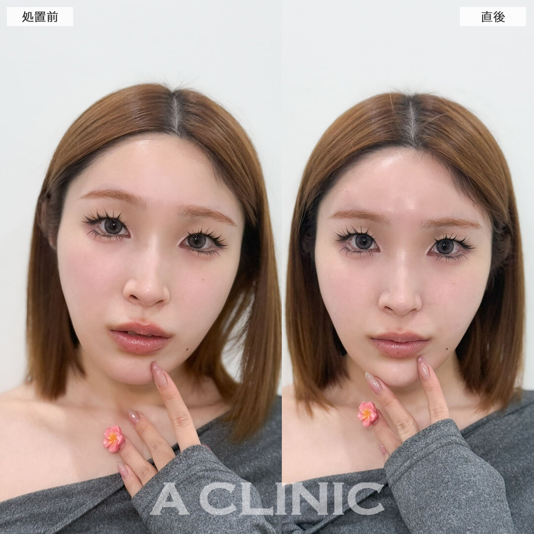 ヒアルロン酸カスタマイズメニューはナチュラルな立体感が欲しい方におすすめの施術です！こちら処置前と直後の症例です(20代女性)