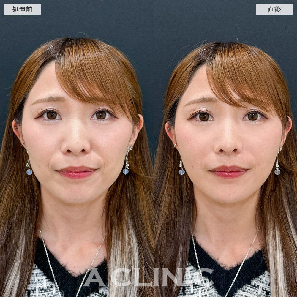 ヒアルロン酸カスタマイズメニューで頬コケとほうれい線の影が解消されました！こちら処置前と直後の症例です。(30代女性)