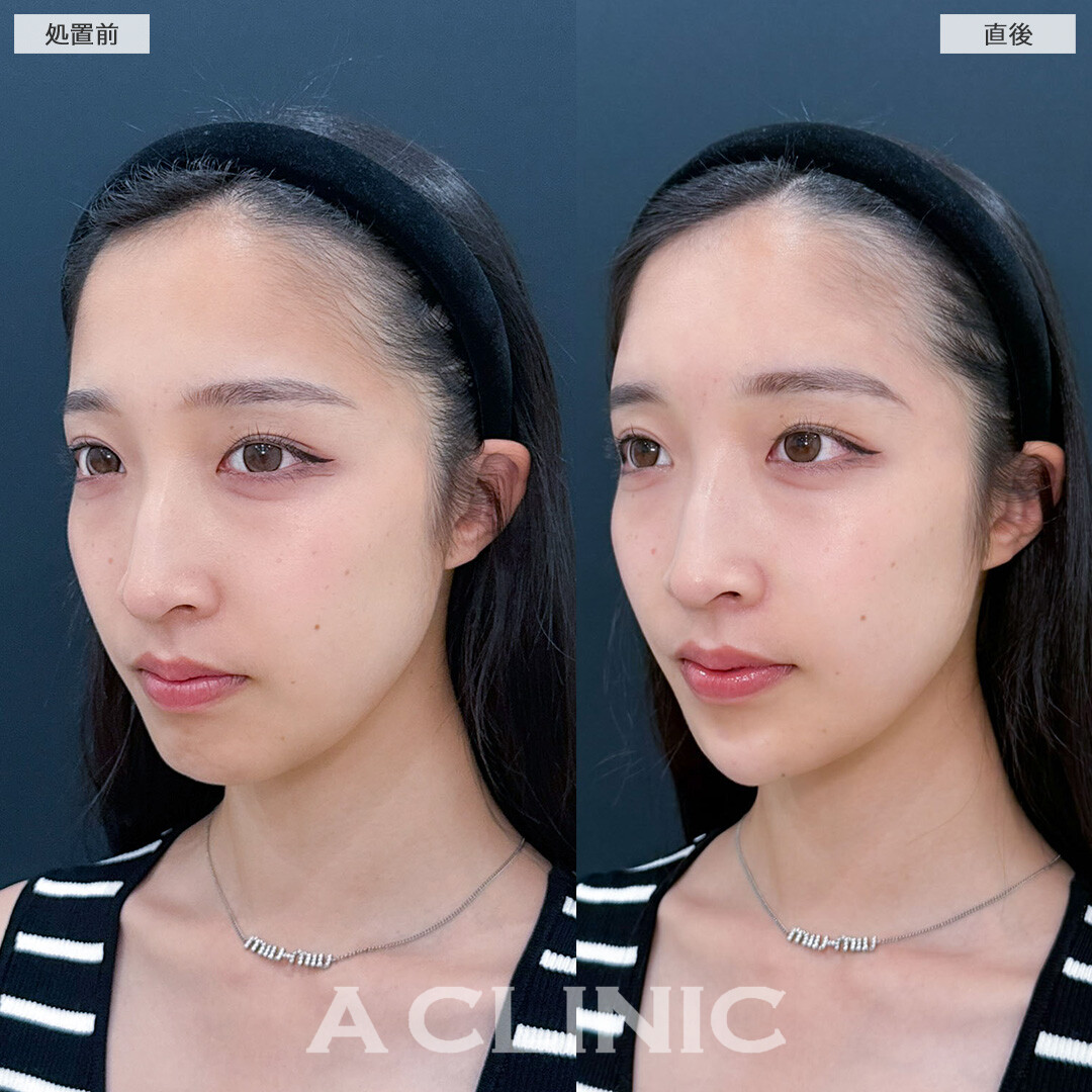 ヒアルロン酸カスタマイズメニューで立体感を出し面長解消！こちら処置前と直後の症例です(20代女性)