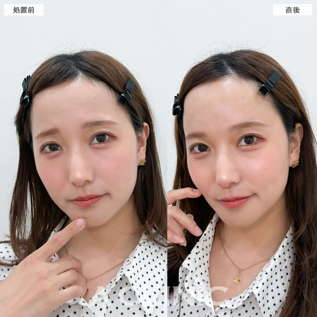 ヒアルロン酸カスタマイズメニューで面長感解消しました！こちら処置前と直後の症例です(30代女性)