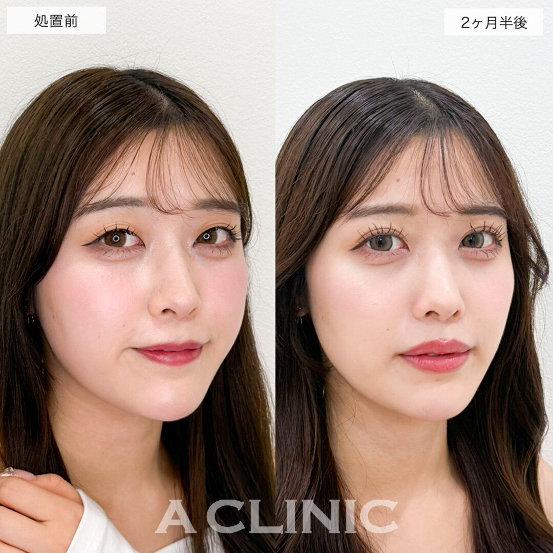 二重術埋没法でアイプチ卒業し華やかな目元に!こちら処置前と2ヶ月半後の症例です(20代女性)