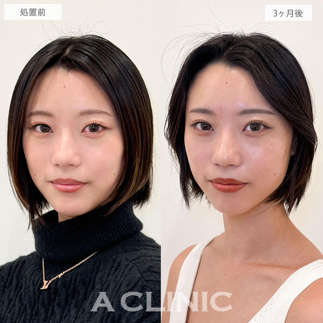 二重術埋没法でぼやけた二重幅を解消！こちら処置前と3ヶ月後の症例です(20代女性)