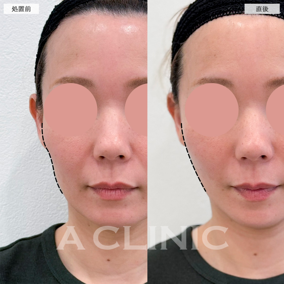 頬へのヒアルロン酸注入で頬こけが改善しシャープなフェイスラインに！処置前と直後の症例です(40代女性)