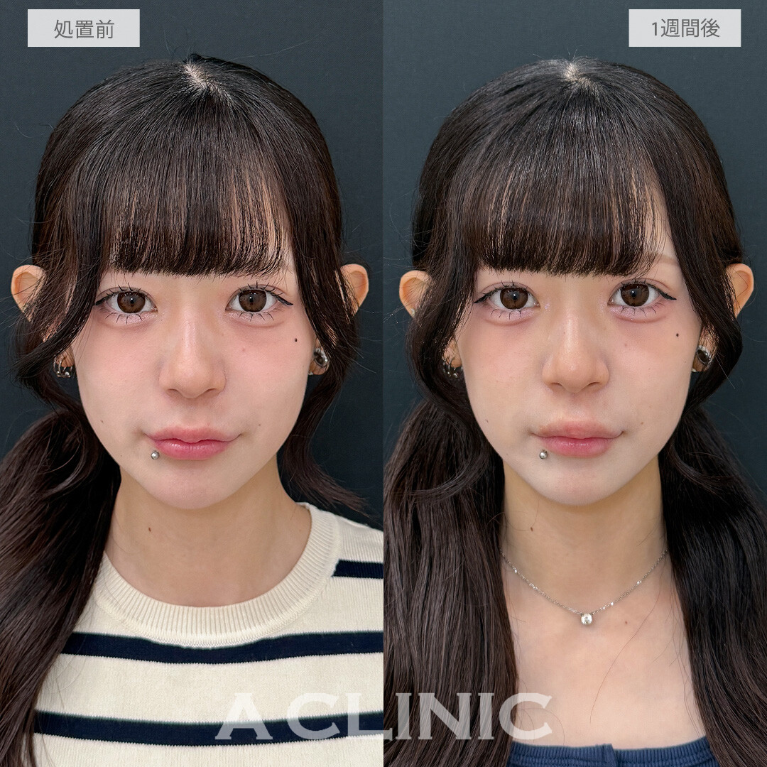 切らない人中短縮ならほとんど傷跡は目立ちません！切らない人中短縮(Cカール形成術)の処置前と1週間後の症例です(20代女性)