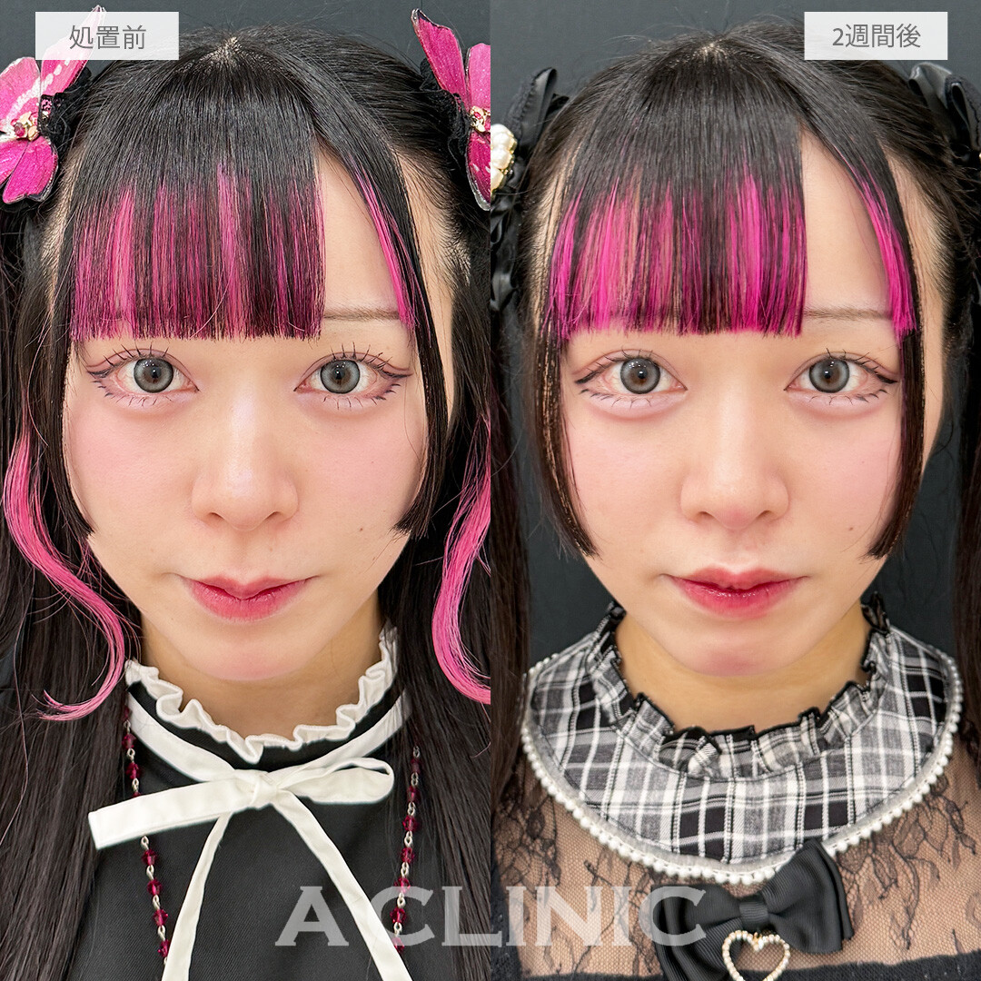 人中が短くなるとお顔全体のバランスが整います！こちら切らない人中短縮(Cカール形成術)の処置前と2週間後の症例です(20代女性)