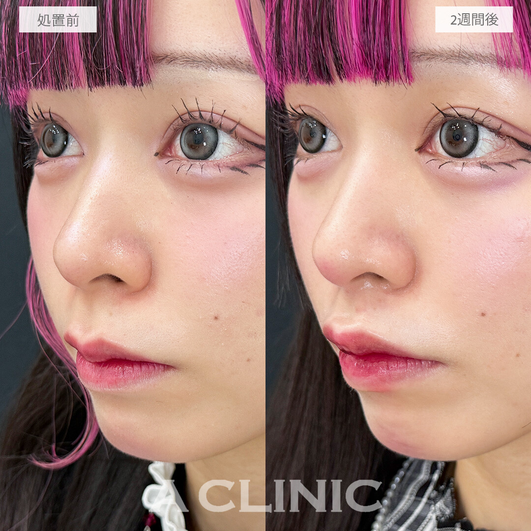 人中が短くなるとお顔全体のバランスが整います！こちら切らない人中短縮(Cカール形成術)の処置前と2週間後の症例です(20代女性)