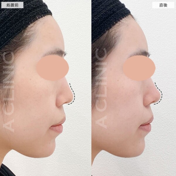 コリアンノーズで横顔が映えるツンとした鼻先に！処置前と直後の症例です(20代女性)