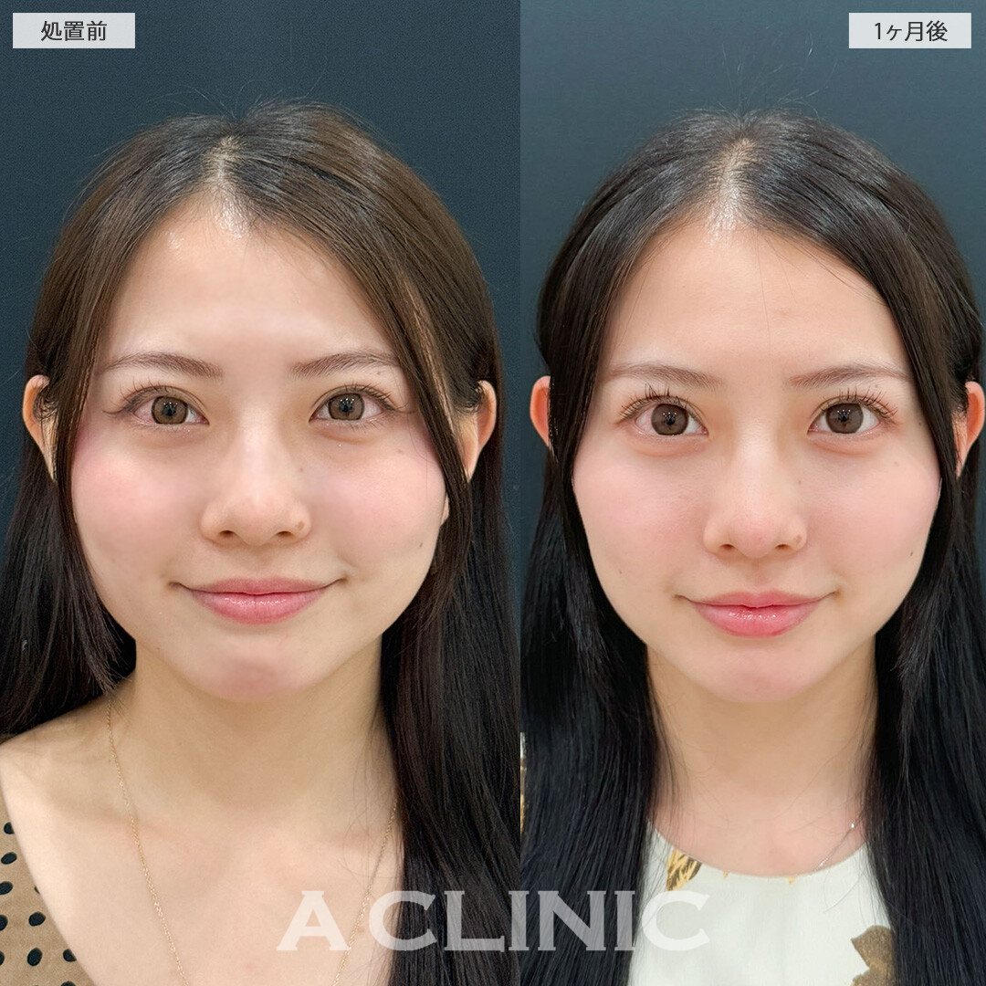 目の下のクマ取りで可愛さ更にアップデートされました！こちら処置前と1ヶ月後の症例です(20代女性)