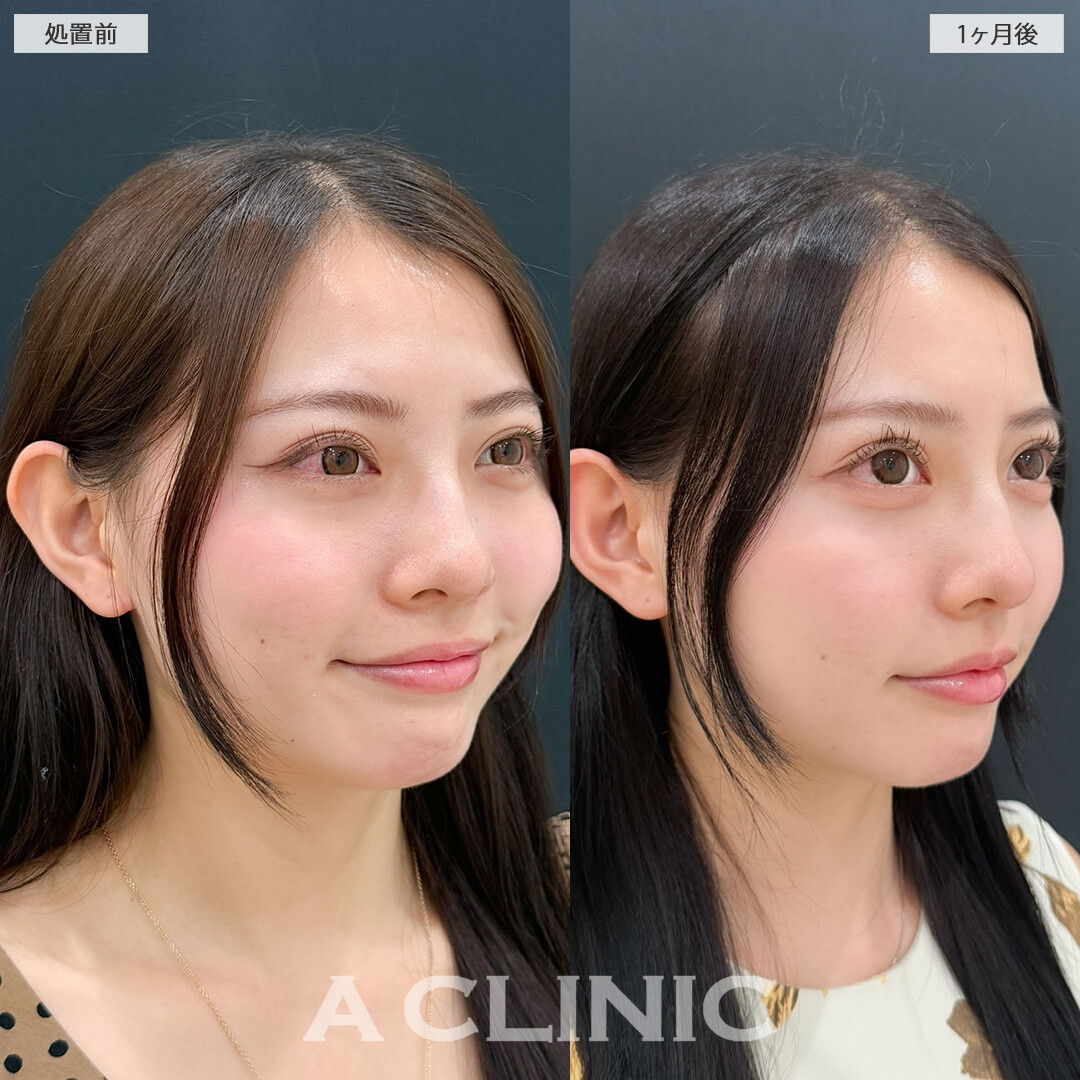 目の下のクマ取りで可愛さ更にアップデートされました！こちら処置前と1ヶ月後の症例です(20代女性)