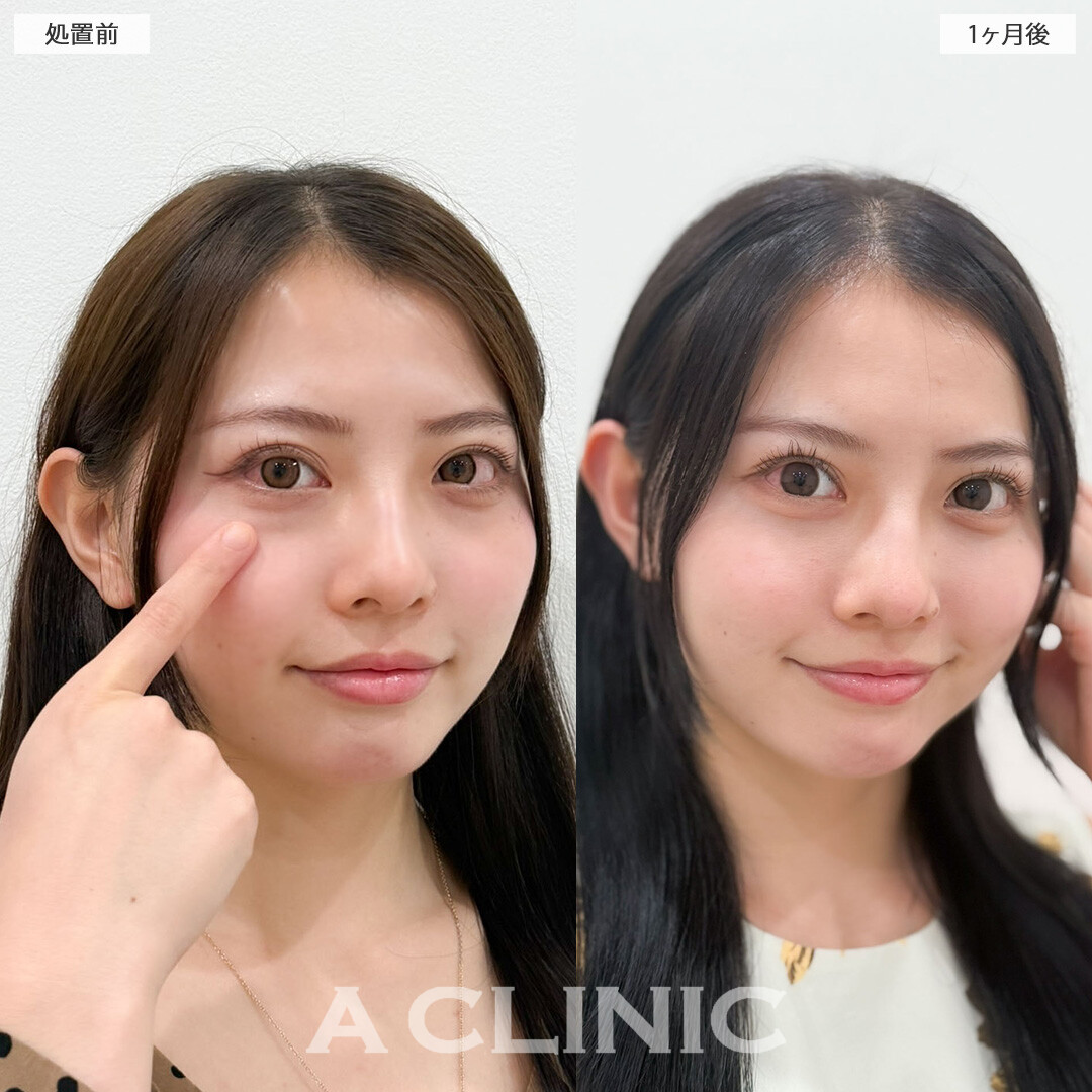 目の下のクマ取りで可愛さ更にアップデートされました！こちら処置前と1ヶ月後の症例です(20代女性)