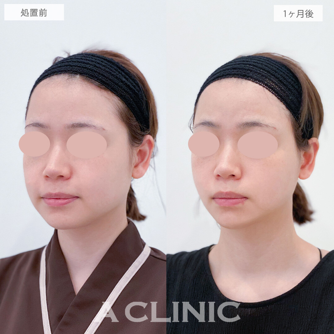 1day小顔脂肪吸引で悩んでいた下膨れがスッキリしました！処置前と1ヶ月後の症例です(20代女性)