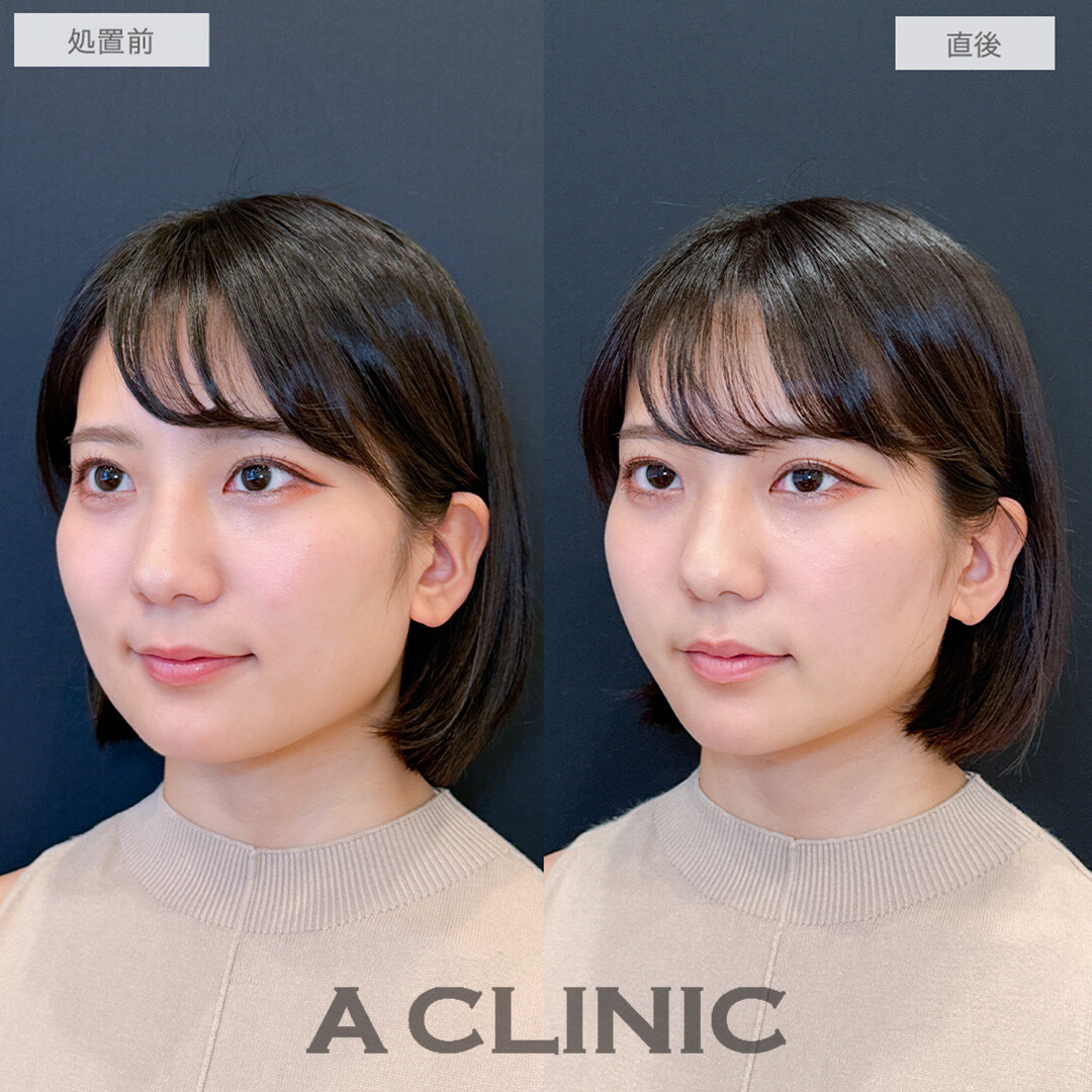 Aスレッドでどこから見ても綺麗なフェイスラインが爆誕しました！処置前と直後の症例です(20代女性)