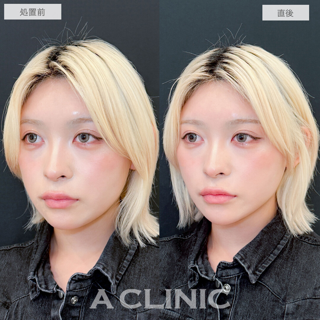 Aスレッドでフェイスラインを整え中顔面短縮！処置前と直後の症例です(20代女性)