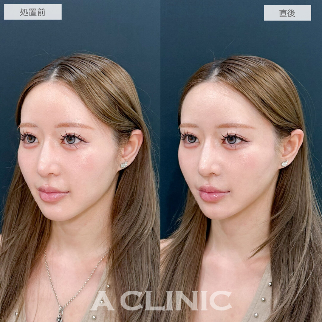 Aスレッドでどこから見てもスッキリとしたフェイスラインが誕生しました！処置前と直後の症例です(20代女性)
