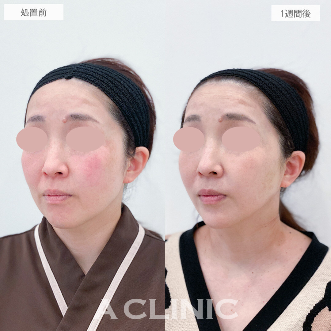 A式美肌たるみ切開で若返りが可能に！処置前と1週間後の症例です(40代女性)