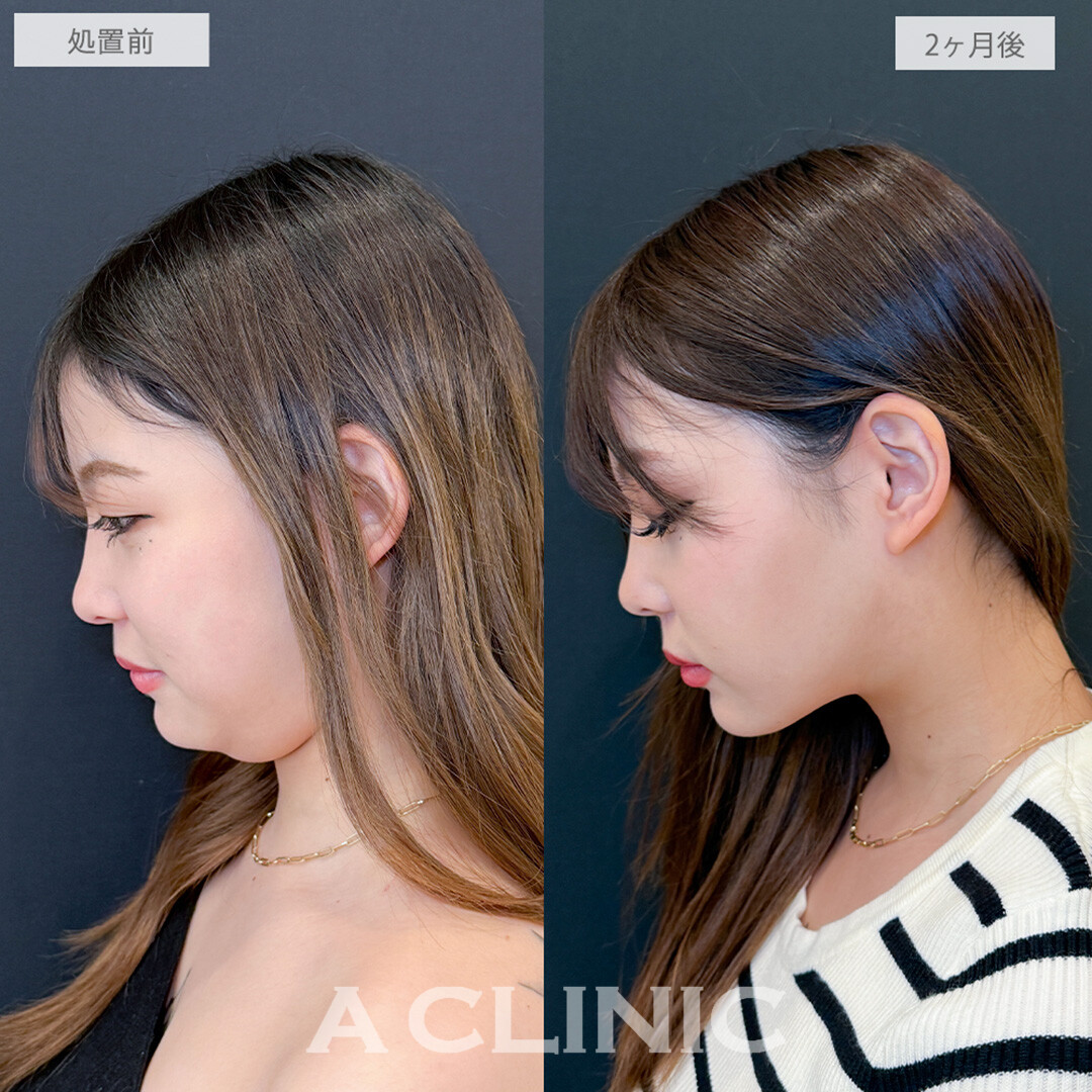 1day小顔脂肪吸引とあごへのヒアルロン酸注入と小顔エラボトックスで頑固な二重あごもなくなりお顔がひと回り小さくなりました！処置前と2ヶ月後の症例です(20代女性)