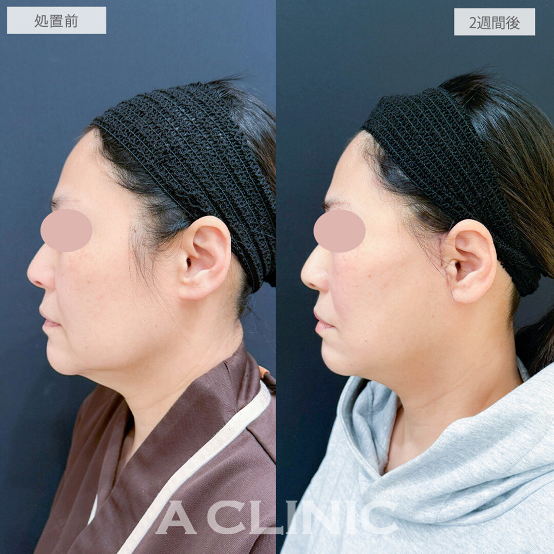 1day小顔脂肪吸引とA式美肌たるみ切開で劇的な若返りが可能に！処置前と2週間後の症例です(40代女性)