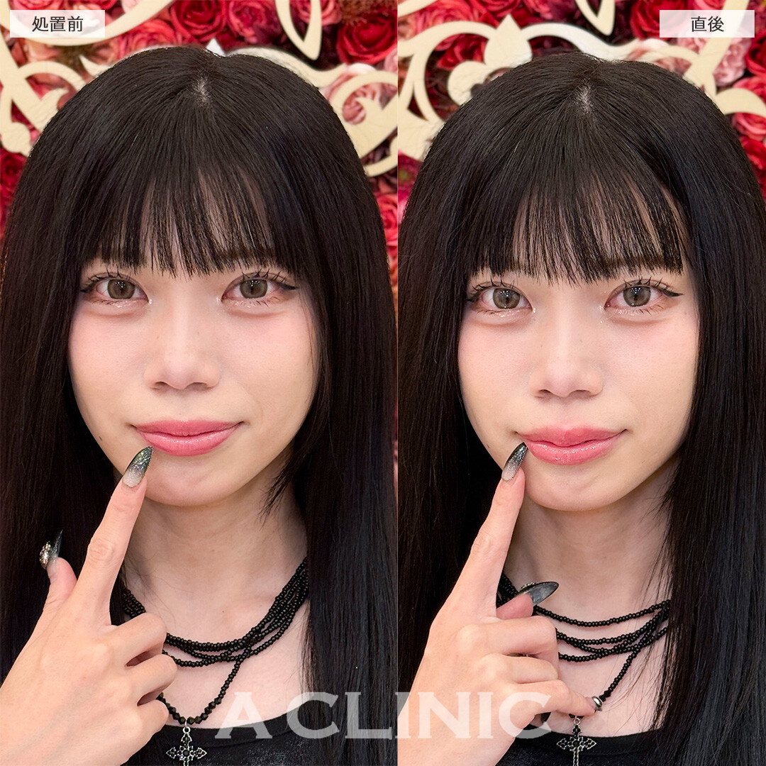 スマイルリップで上唇のボリュームアップ！処置前と直後の症例です(20代女性)
