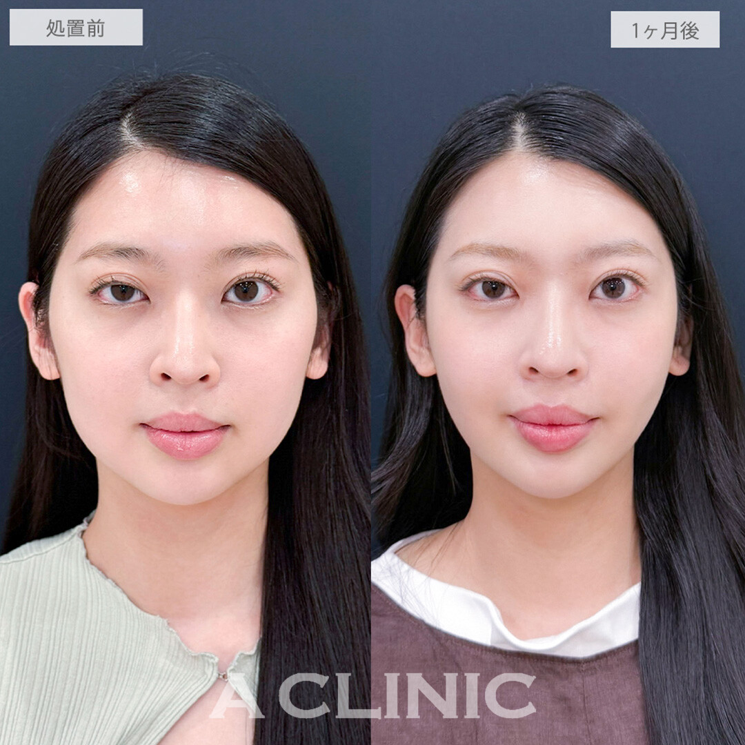 1day小顔脂肪吸引で憧れのVフェイス美女に大変身しました！処置前と1ヶ月後の症例です(20代女性)