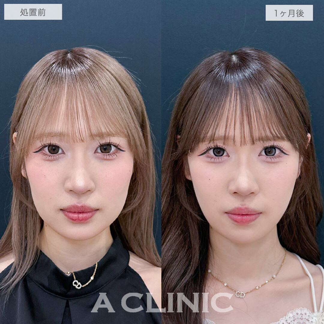 1day小顔脂肪吸引でぼやけていたフェイスラインがくっきりVフェイスに！処置前と1ヶ月後の症例です(20代女性)
