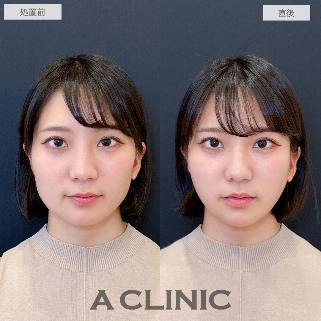 Aスレッドでどこから見ても綺麗なフェイスラインが爆誕しました！処置前と直後の症例です(20代女性)