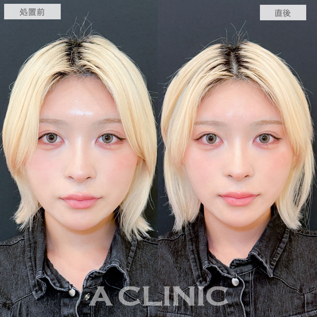 Aスレッドでフェイスラインを整え中顔面短縮！処置前と直後の症例です(20代女性)