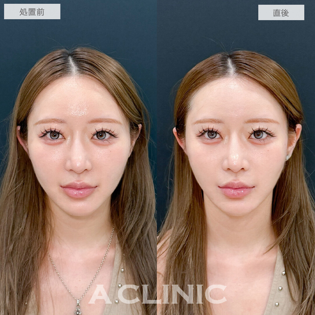 Aスレッドでどこから見てもスッキリとしたフェイスラインが誕生しました！処置前と直後の症例です(20代女性)