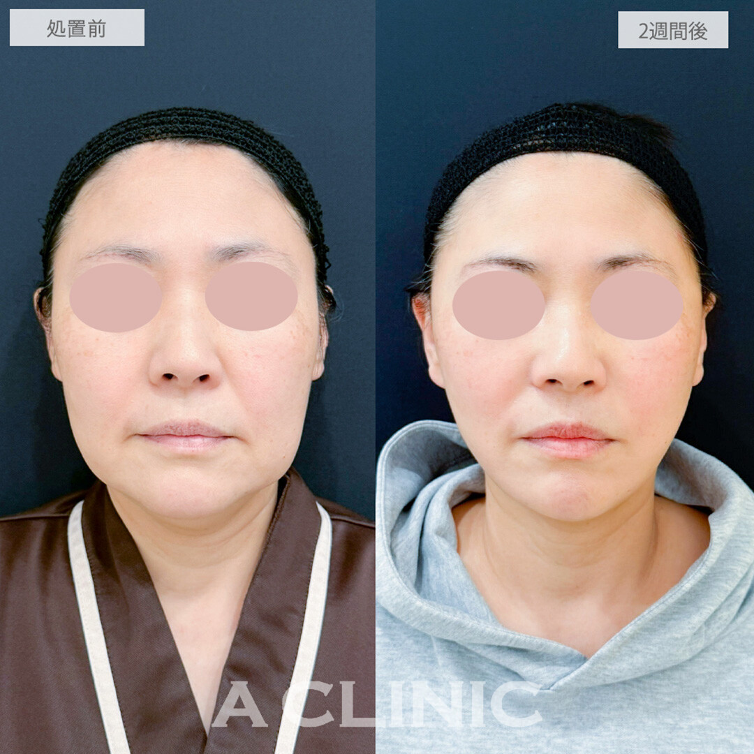 1day小顔脂肪吸引とA式美肌たるみ切開で劇的な若返りが可能に！処置前と2週間後の症例です(40代女性)