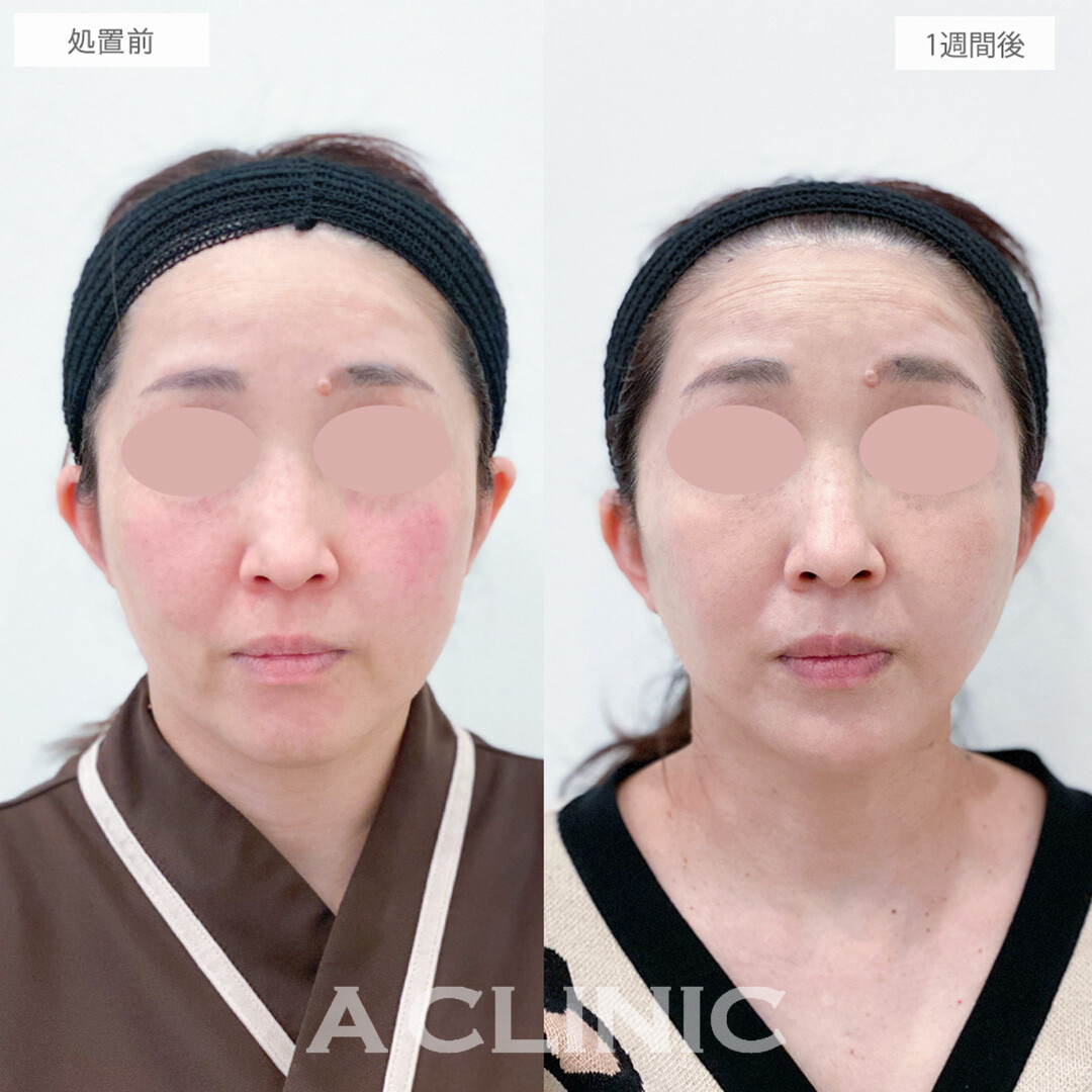 A式美肌たるみ切開で若返りが可能に！処置前と1週間後の症例です(40代女性)