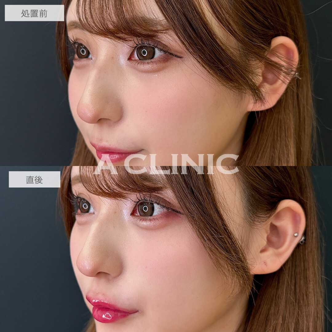 ヒアルだけで中顔面を短縮できます！涙袋形成術(ヒアルロン酸)とリップヒアルロン酸注入の処置前と直後の症例です(20代女性)
