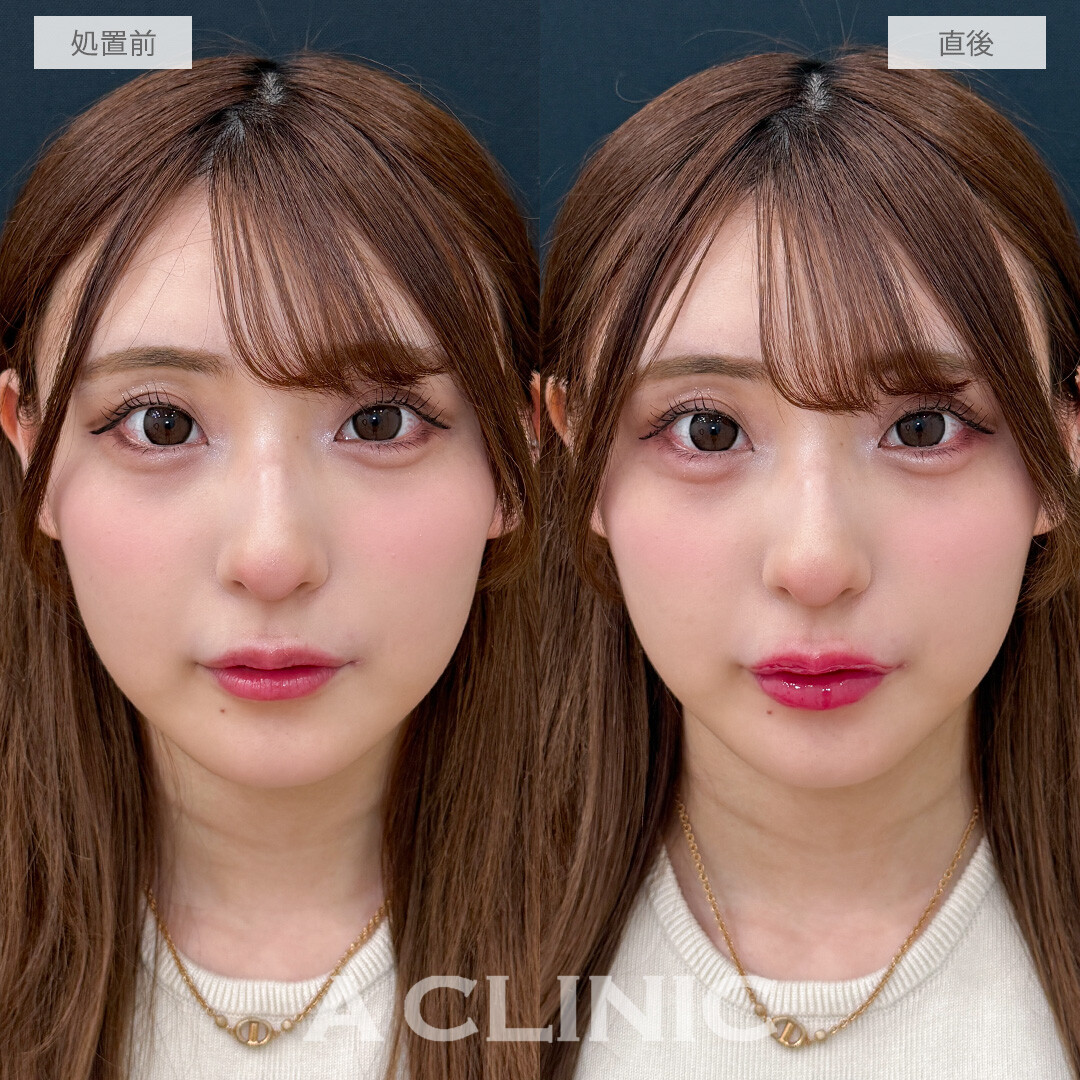 ヒアルだけで中顔面を短縮できます！涙袋形成術(ヒアルロン酸)とリップヒアルロン酸注入の処置前と直後の症例です(20代女性)