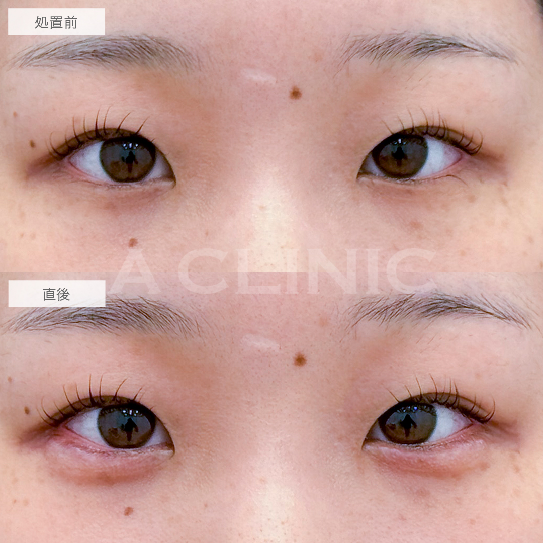 涙袋形成術(ヒアルロン酸)で存在感のある涙袋に！処置前と直後の症例です(20代女性)