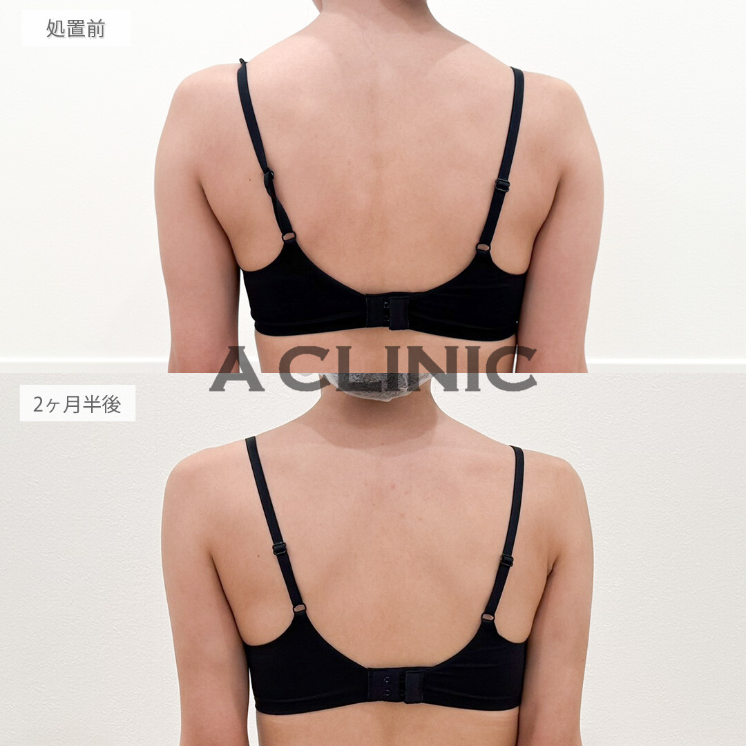 二の腕スリム脂肪吸引で部分痩せに成功！処置前と2ヶ月半後の症例です(20代女性)