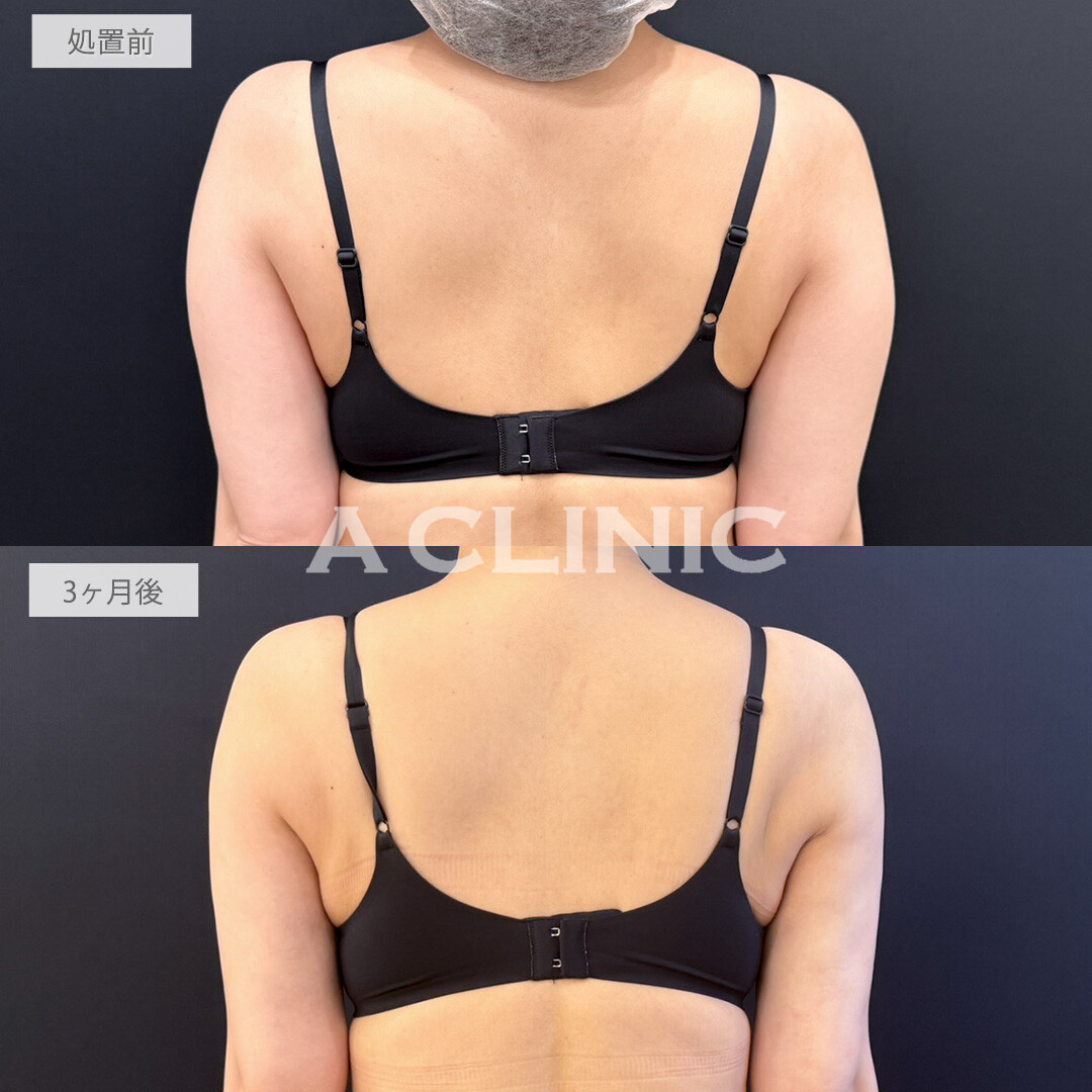 二の腕スリム脂肪吸引でピンポイントで余分な脂肪を取り除き華奢な身体に！処置前と3ヶ月後の症例です(40代女性)