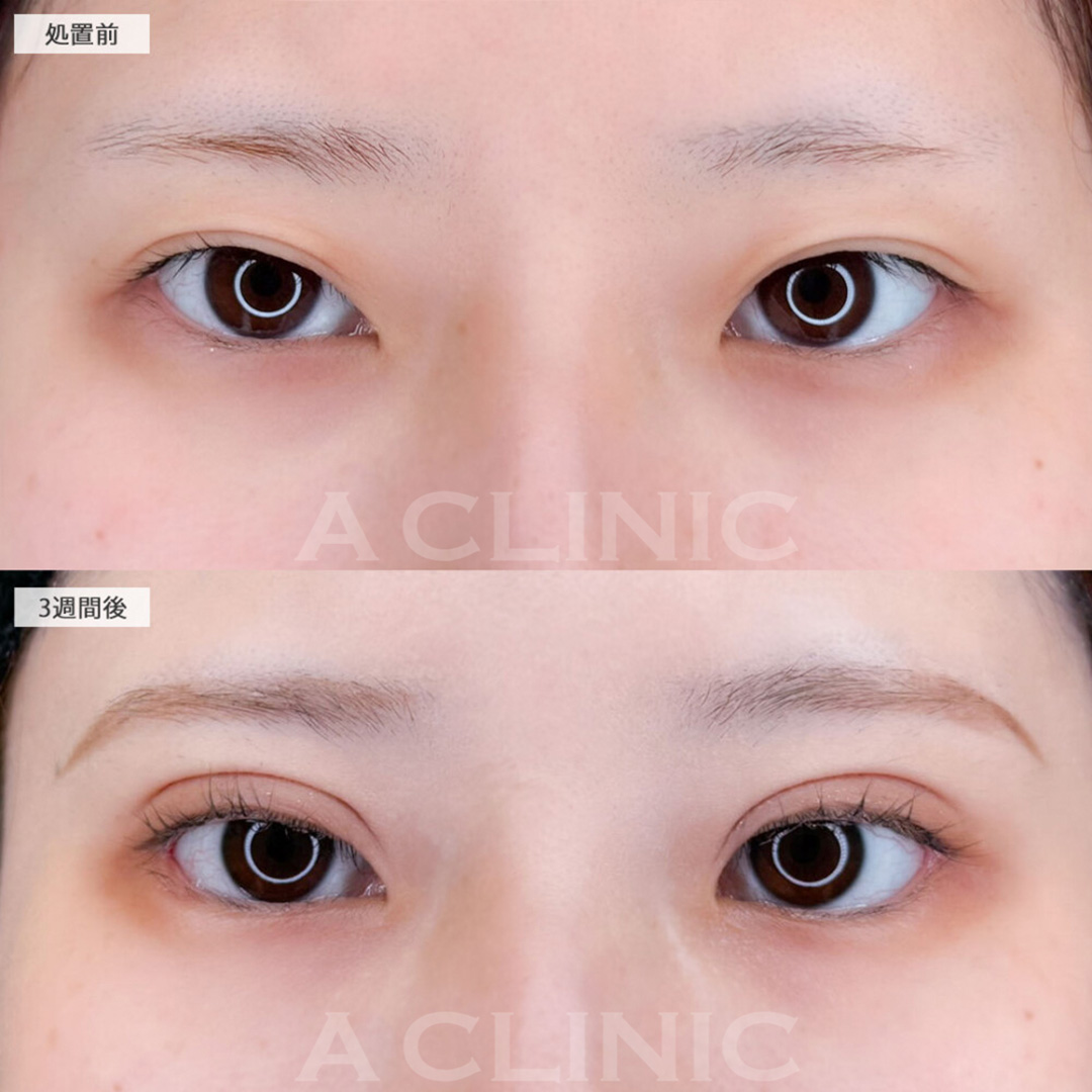 パーフェクトアイズと二重術埋没法で更にきれいな印象の瞳に！こちら処置前と3週間後の症例です(20代女性)