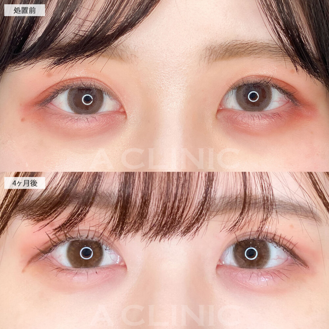 パーフェクトアイズでナチュラルにぱっちりタレ目に！こちら処置前と4ヶ月後の症例です(20代女性)