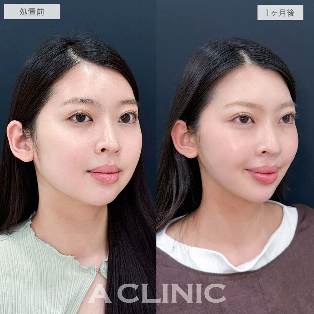 1day小顔脂肪吸引で憧れのVフェイス美女に大変身しました！処置前と1ヶ月後の症例です(20代女性)